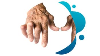 The hand of a person with rheumatoid arthritis