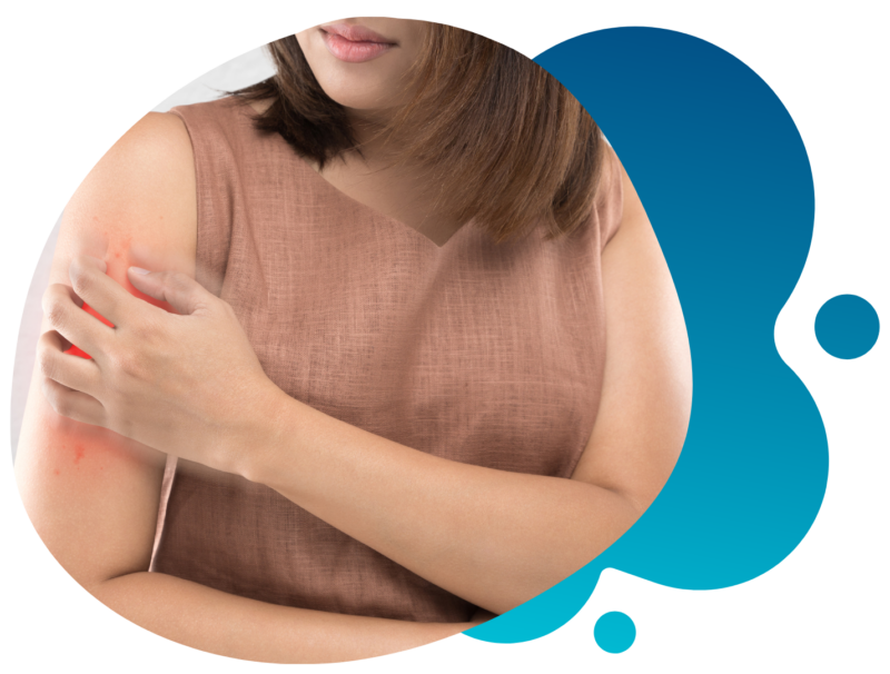 Psoriasis Symptoms Causes amp Risk Factors NIAMS