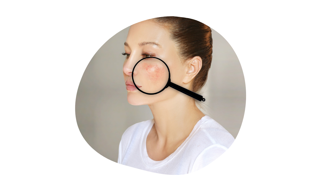 lupus magnify 2