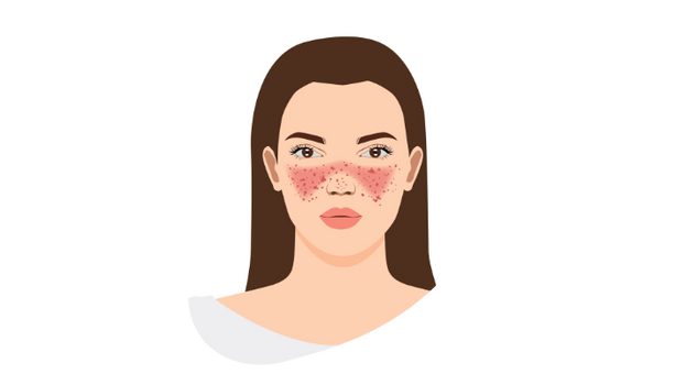Lupus Graphic 2