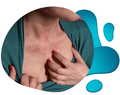 woman scratching hives on chest