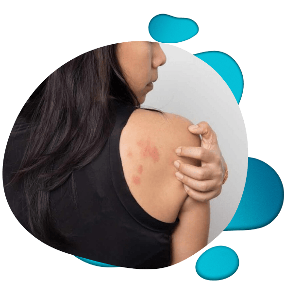 Website Elements (1200 x 800 px) (706 x 656 px) (6) woman scratching hives on back