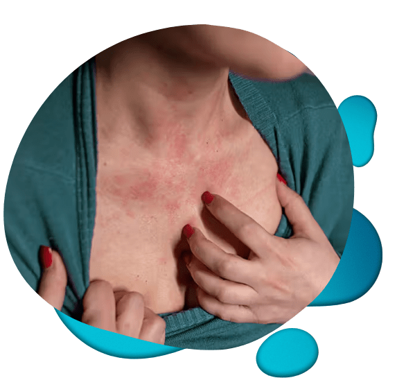 Website Elements (1200 x 800 px) (706 x 656 px) (9) zoom in of hives on chest