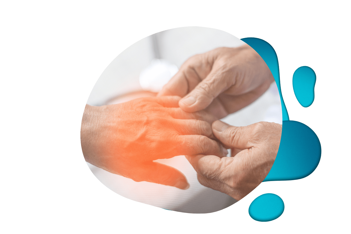 Person with inflamed red joints on hand indicating arthritis symptoms