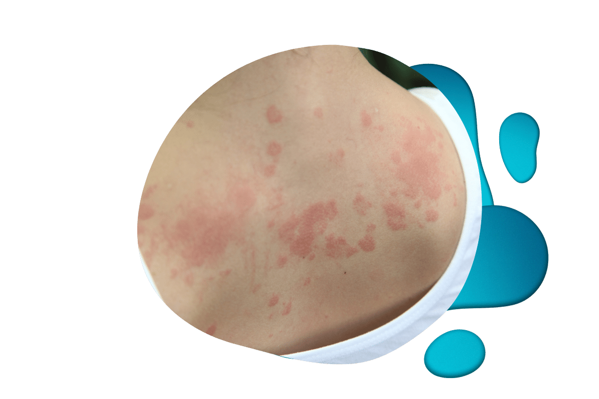 Imagen de estudios actuales sobre la urticaria